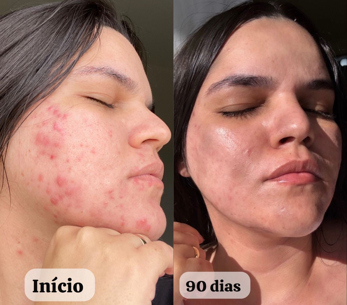 Kit Completo para Acne Hormonal e Resistente
